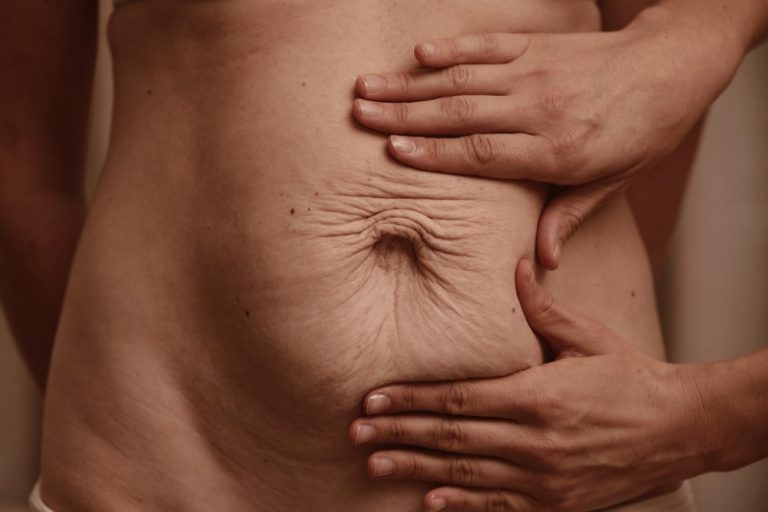 Da li imate opuštenu kožu? 6 Koza vam je opustena Celulit ekspert - Celulit Ekspert - Lider u estetskoj i fizikalnoj terapiji